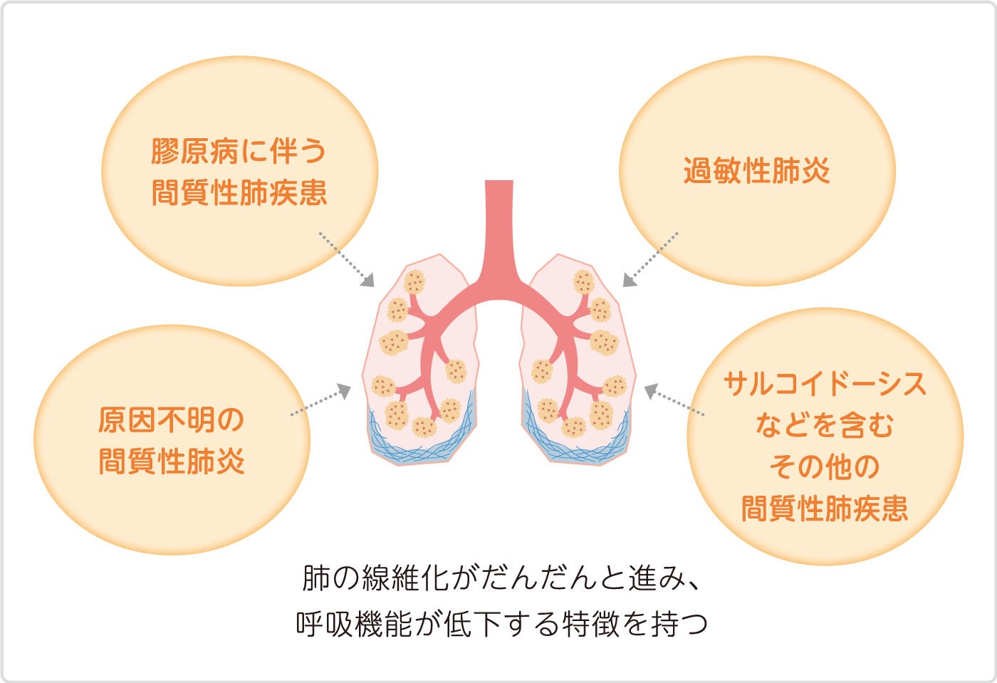 肺の線維化がだんだんと進み、呼吸機能が低下する特徴を持つ