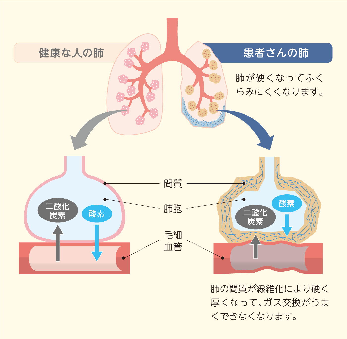 肺の線維化によって肺の症状が起こるしくみ